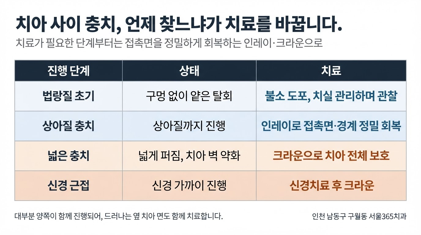 치아 사이 충치, 왜 늦게 발견될까 — 신호와 치료 | 서울365치과 블로그 치아 사이 충치, 왜 늦게 발견될까 — 신호와 치료
