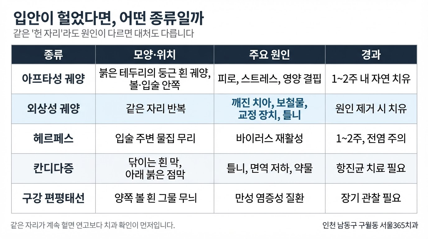 구내염 종류와 원인 — 2주 넘으면 확인해야 하는 이유 | 서울365치과 블로그 구내염 종류와 원인 — 2주 넘으면 확인해야 하는 이유
